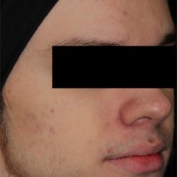AviClear Before & After Patient #1668